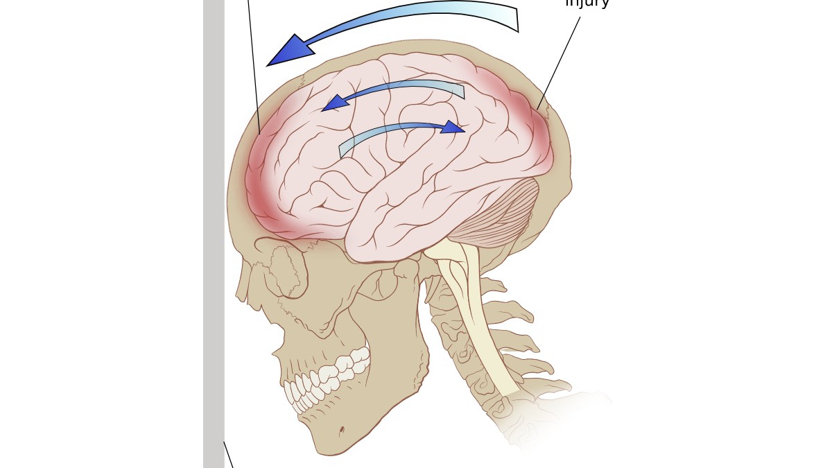 Causa de muerte de Debanhi Escobar, contusión profunda de cráneo, pero qué es