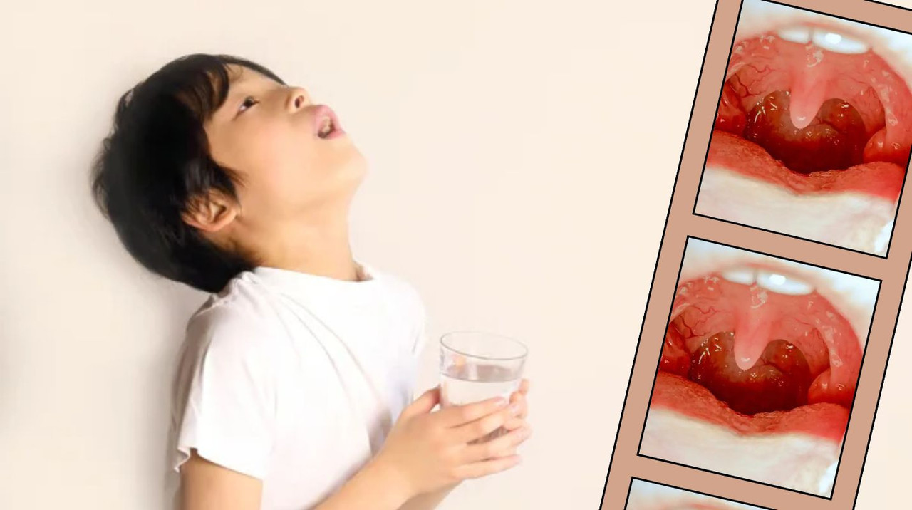 Remedios caseros para infección de garganta