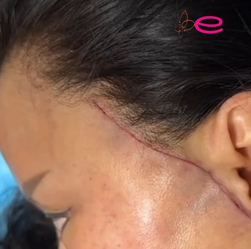 Surgical Facelift