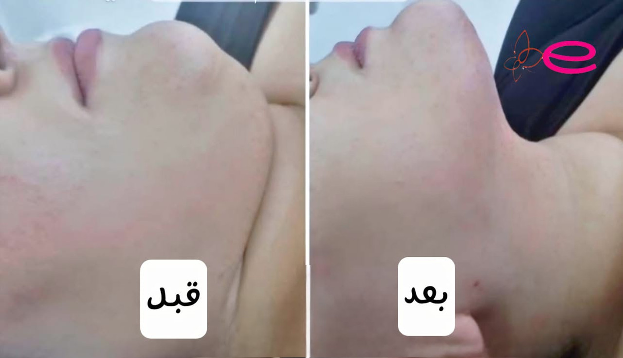 Double Chin Liposuction