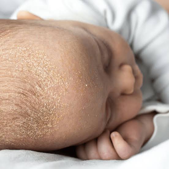 Clinical photograph showing cradle cap – yellow-brown crusty scales on the scalp of a neonate