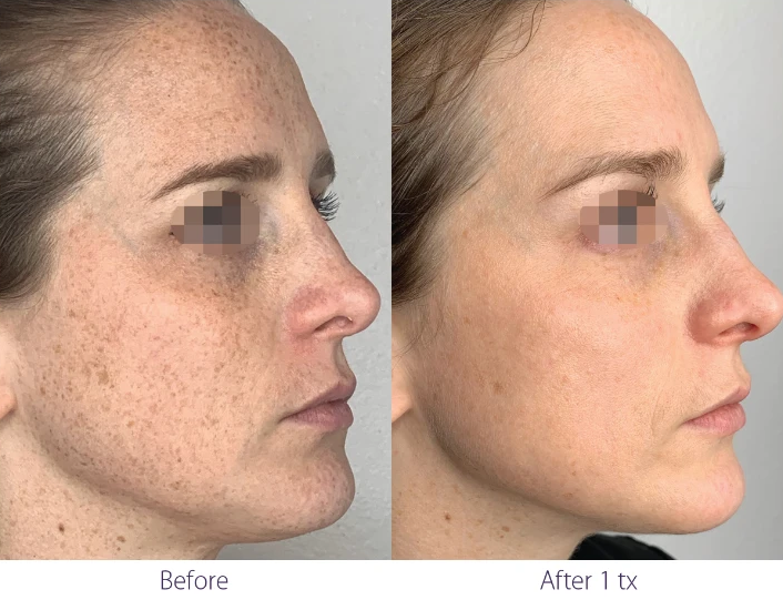 Before and after IPL treatment for sun spots at Let's Face It Med Spa in Denver.