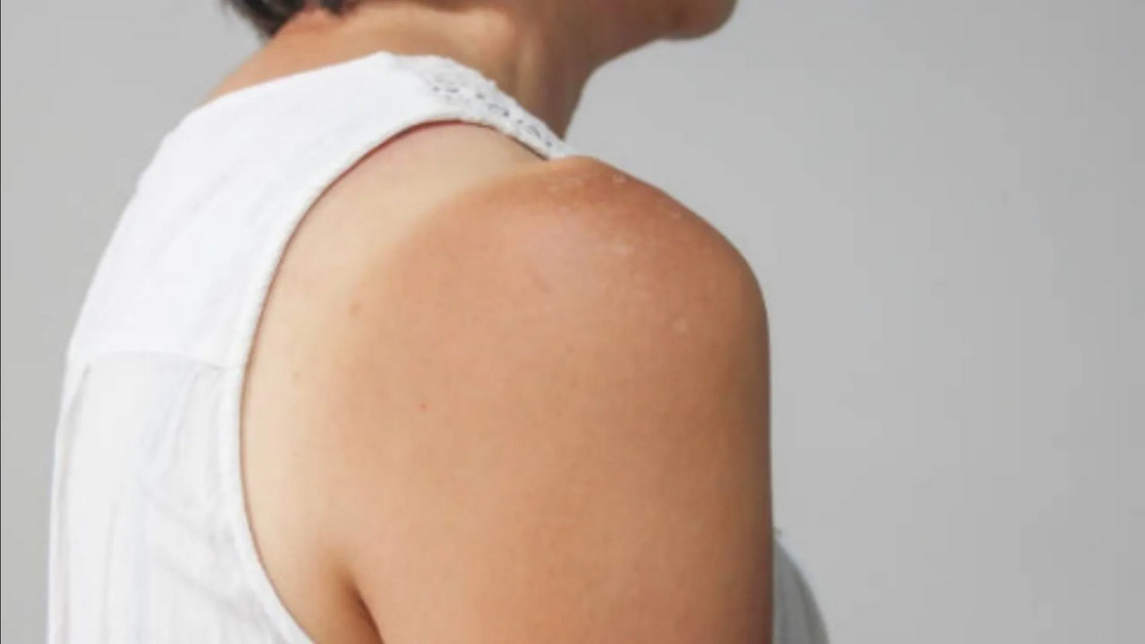 ¿Te asoleaste? Así puedes recuperar el color de tu piel quemada por el sol