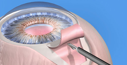 Непроникающая глубокая склерэктомия - хирургия глаукомы.