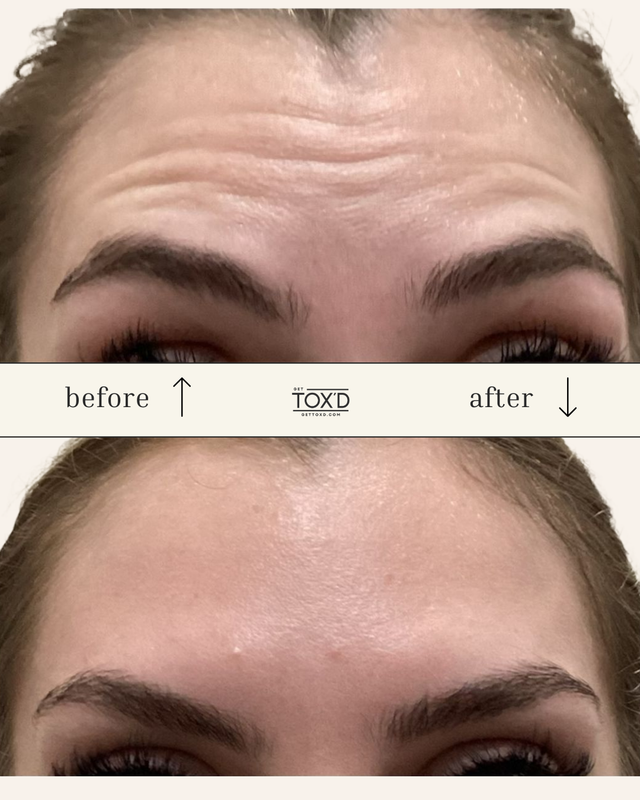 Brotox (Unlimited Upper Face)