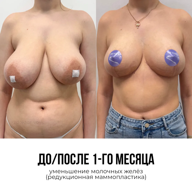 Подтяжка груди без имплантов