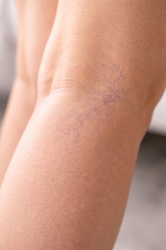 Первые признаки варикоза: когда пора обращаться к врачу