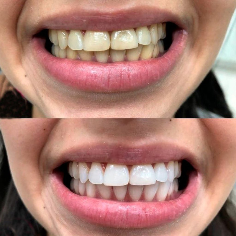 Antes e depois de um tratamento de clareamento dental realizado na clínica