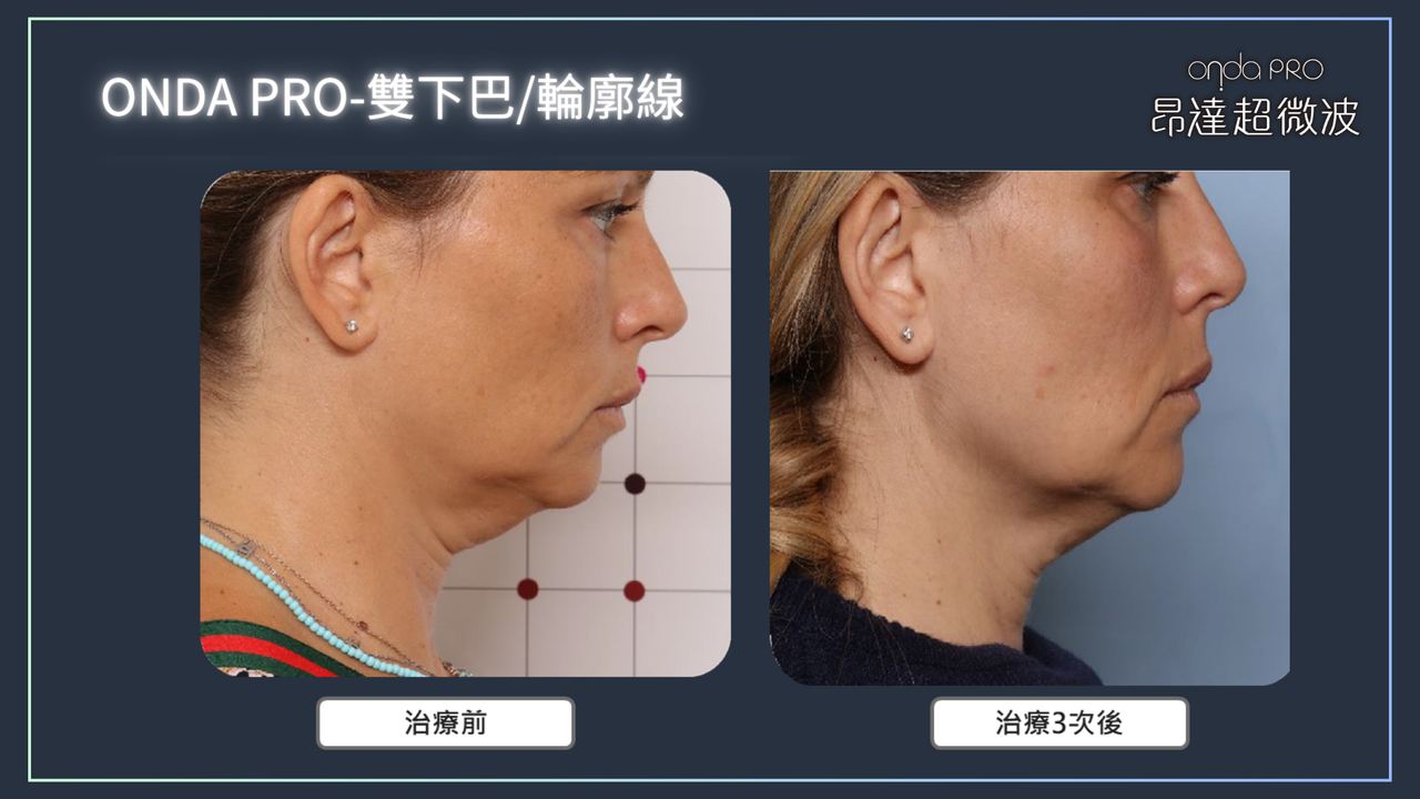 昂達超微波案例：雙下巴