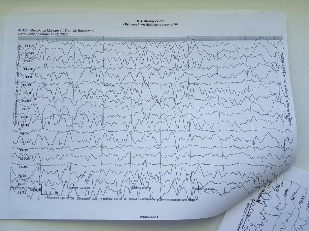Ээг хороший результат. Гипсаритмия на ЭЭГ. ЭЭГ при психических расстройствах. Приступ на ЭЭГ. ЭЭГ при биполярном расстройстве.