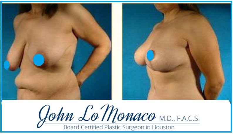 BL No Implant