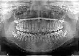 Digital X-Rays & OPG