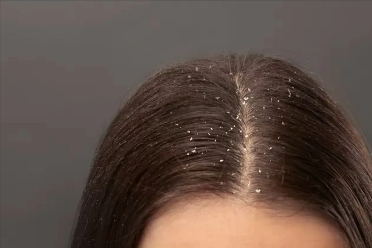 Elimina la caspa con ayuda de cualquiera de estas plantas