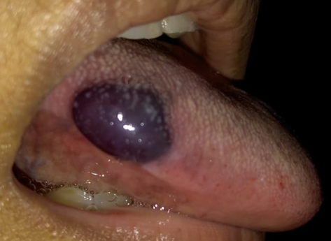 Stress is causing big blood blisters in tongue aka angina bullosa hemorrhagica (ABH)