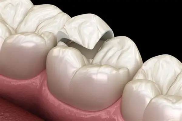 Dental Crown Assessment on Broken Tooth