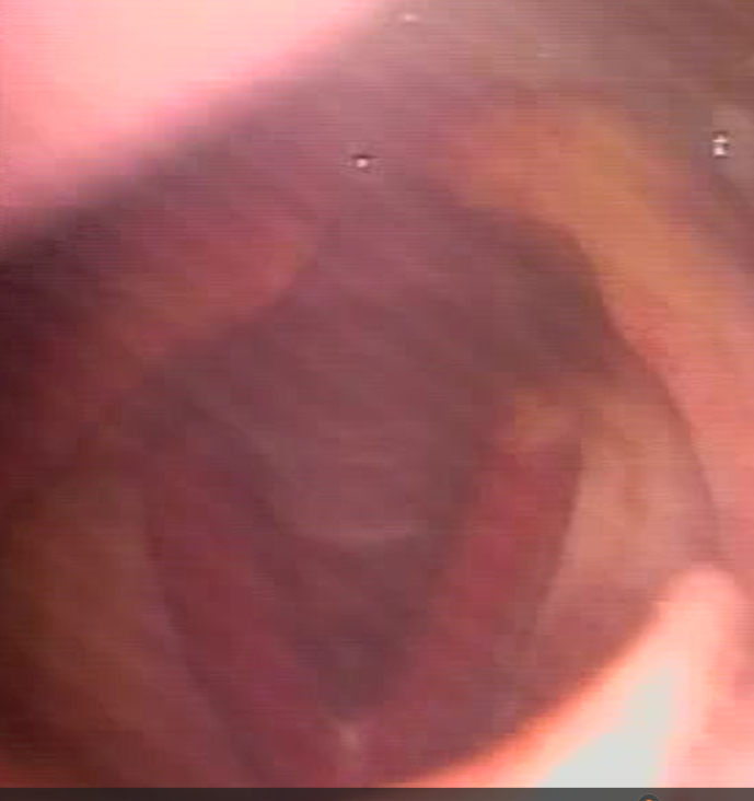 Ruim-aberto.png
