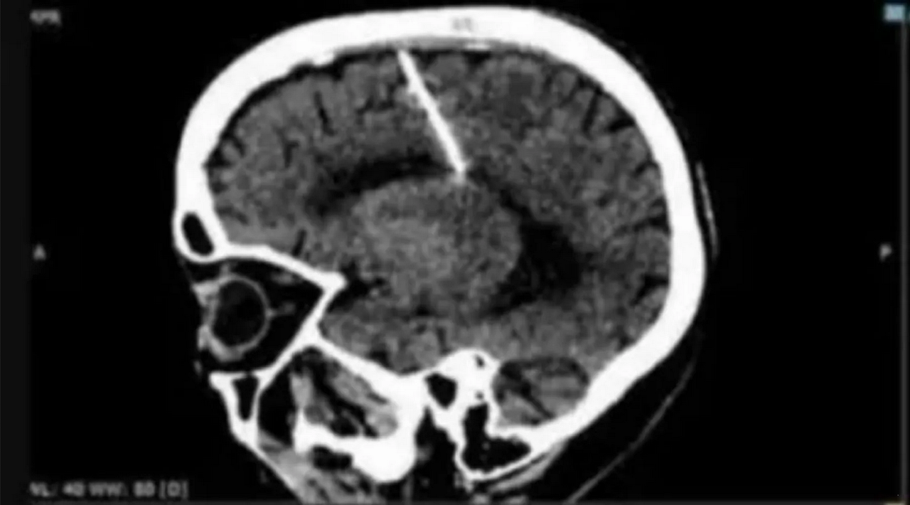 Mujer sobrevive 80 años con aguja en el cerebro ¿cómo llegó hasta ahí?