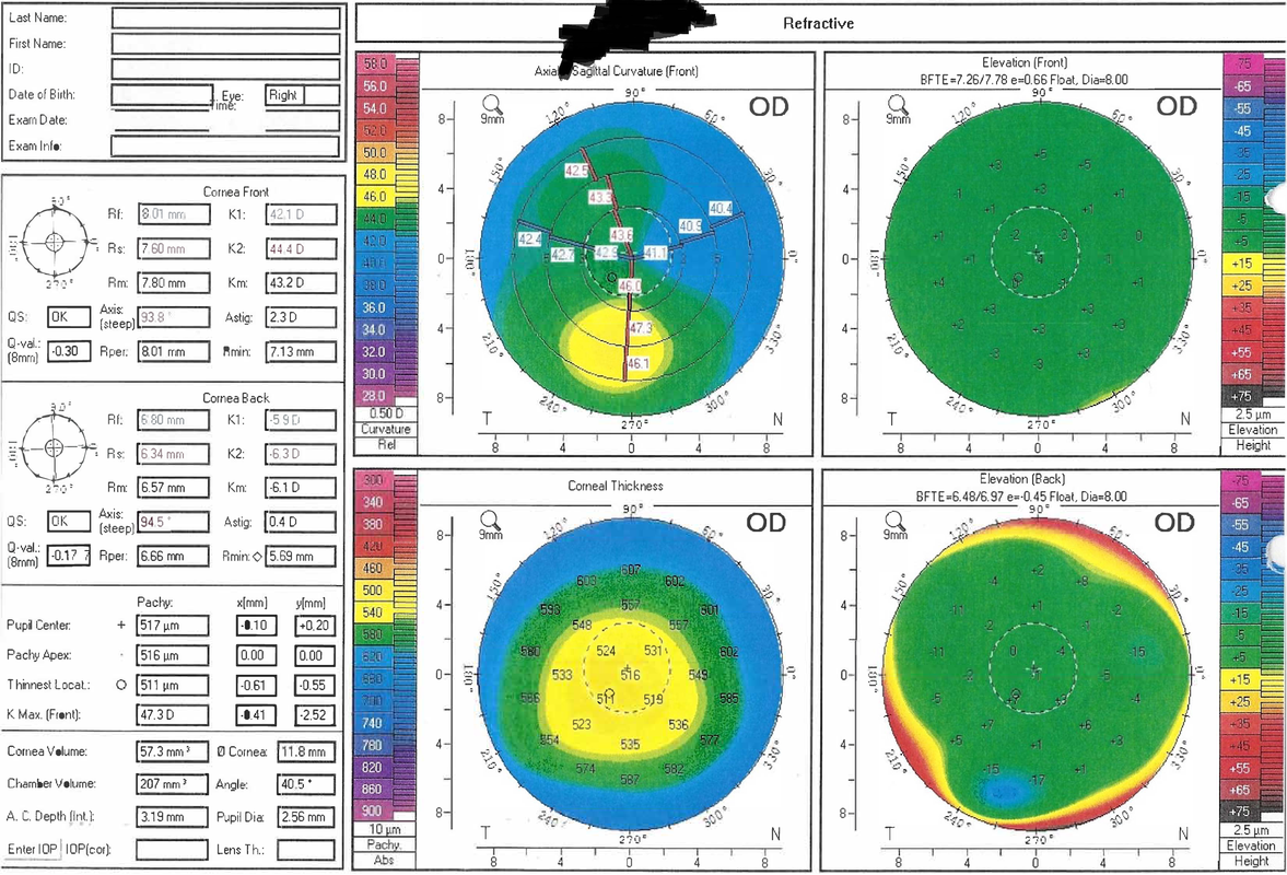 Failed eye stuff (redacted)