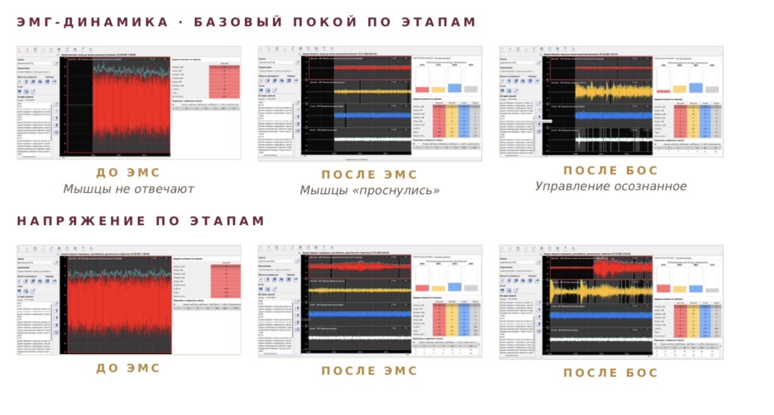 Кейс 2 — ЭМГ по этапам БОС-терапии