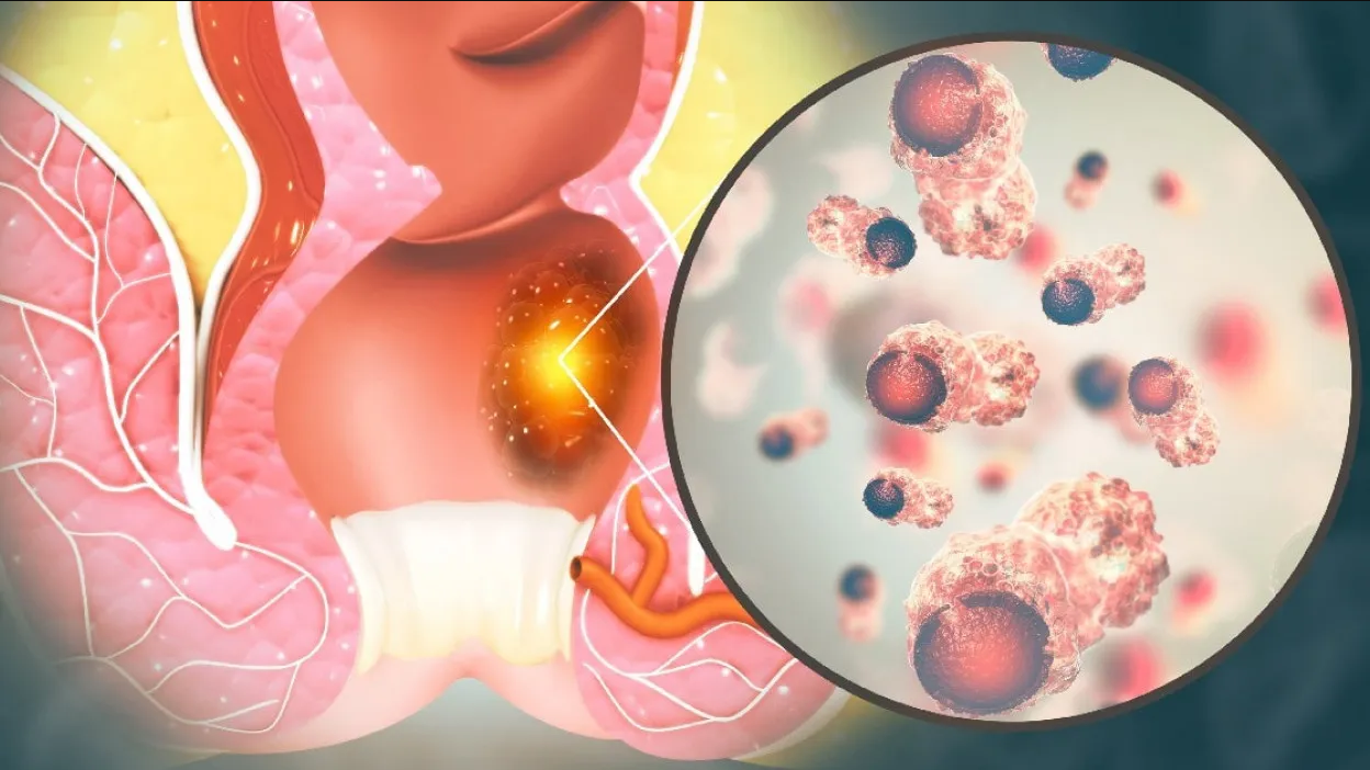 ¿Tengo hemorroides o vph? Conoce la diferencia 