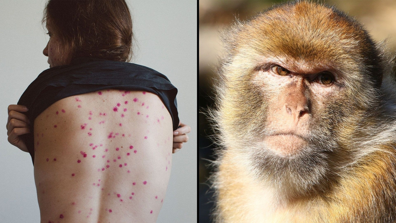 ¿Qué es la viruela del mono?