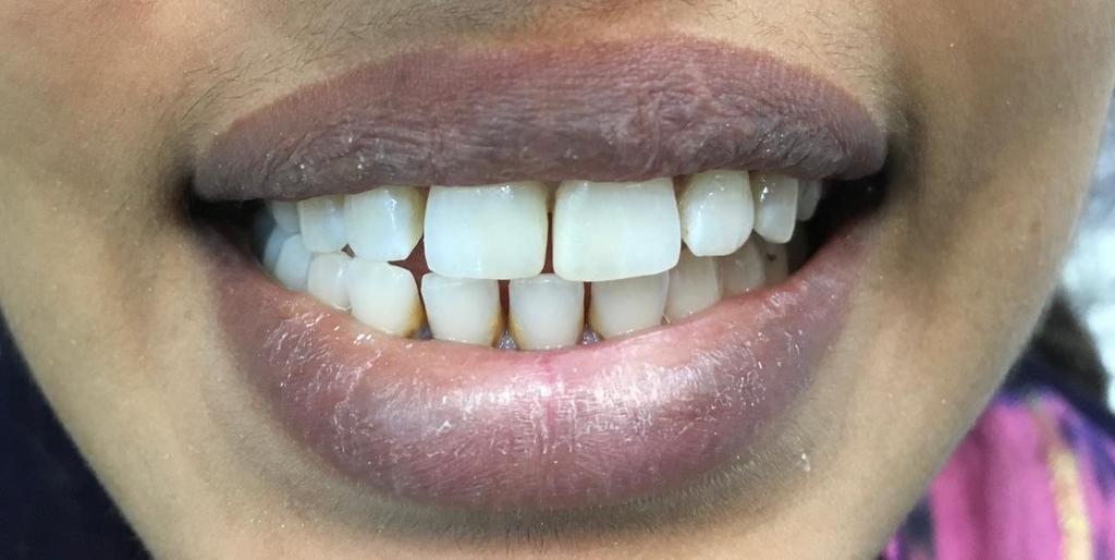 Yellow teeth before
