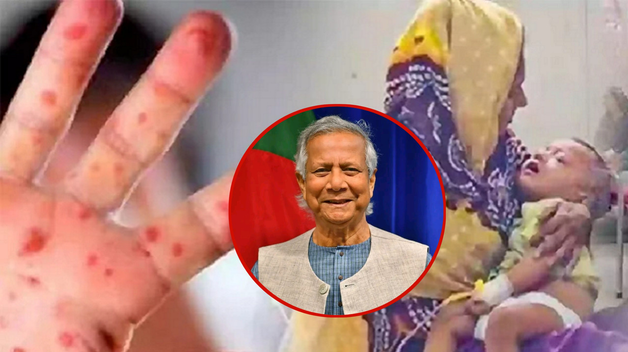শিশুদের হামে মৃত্যু এবং ড ইউনুসের ব্যর্থতা