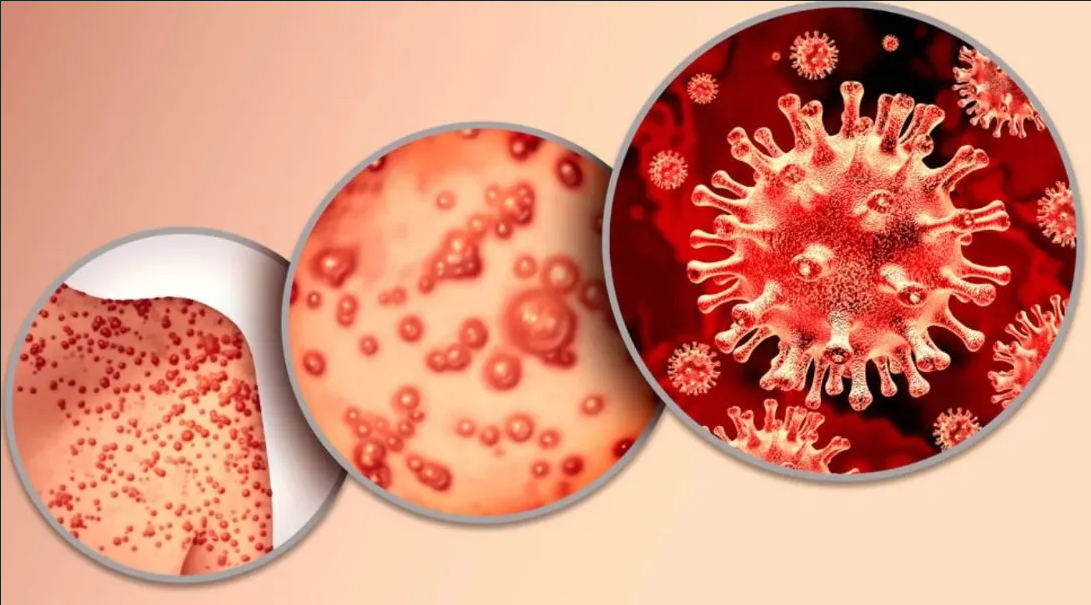 OMS levanta la emergencia internacional por la viruela del mono