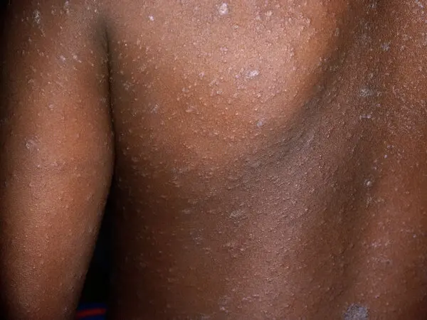 Skin infections treatment