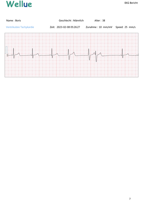 EKG