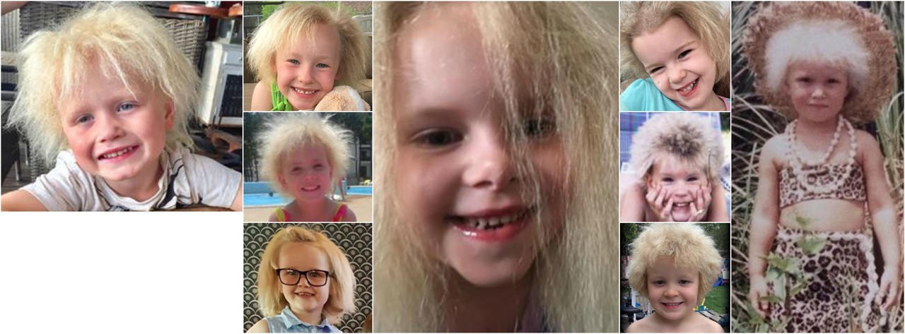 Lock Samples, el niño que sufre el extraño síndrome del cabello impeinable