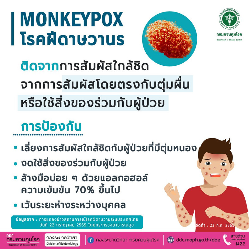 โรค ฝีดาษวานร Monkeypox ติดต่อจากการสัมผัสใกล้ชิดจากการสัมผัสโดยตรงกับตุ่มผื่น หรือใช้สิ่งของร่วมกับผู้ป่วย