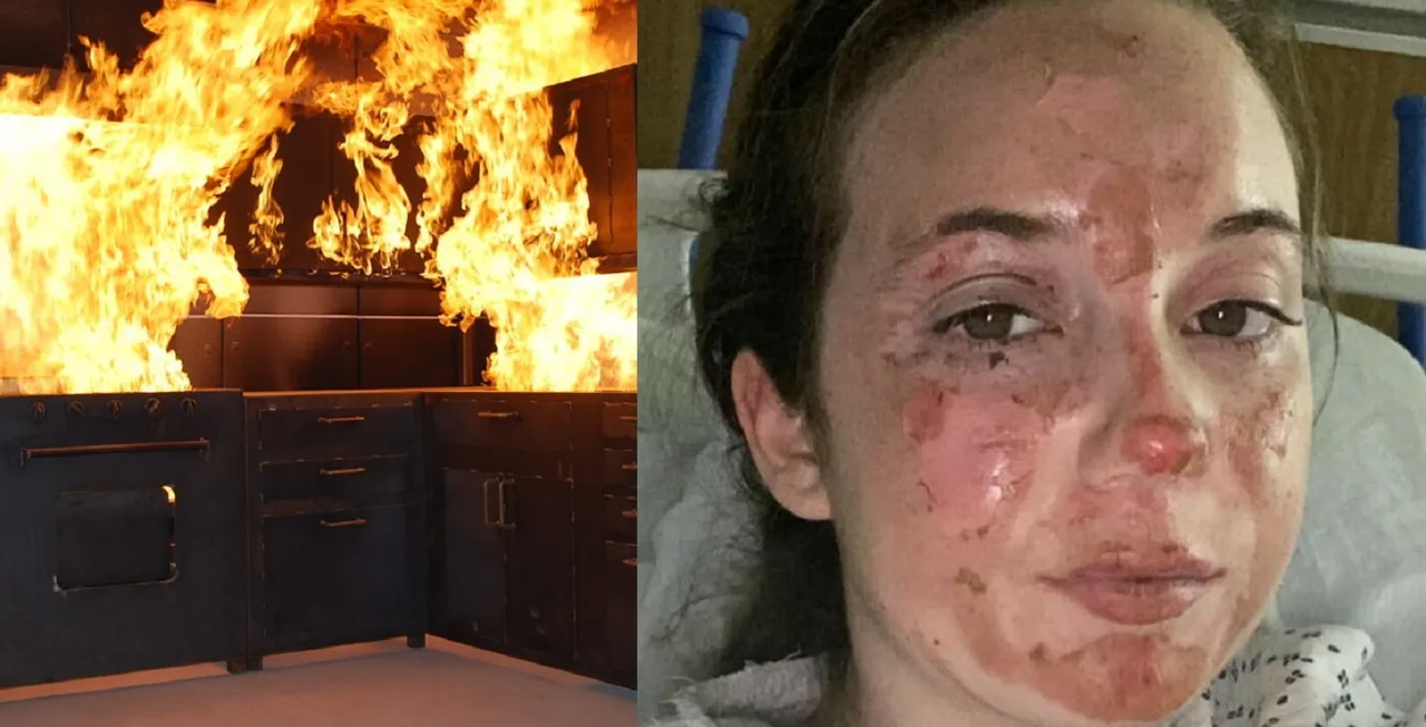 Novia derretida, sufre un terrible accidente días antes de su boda en Carolina