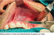 Endodontic Surgeries