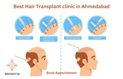 Best Hair Transplant clinic in Ahmedabad