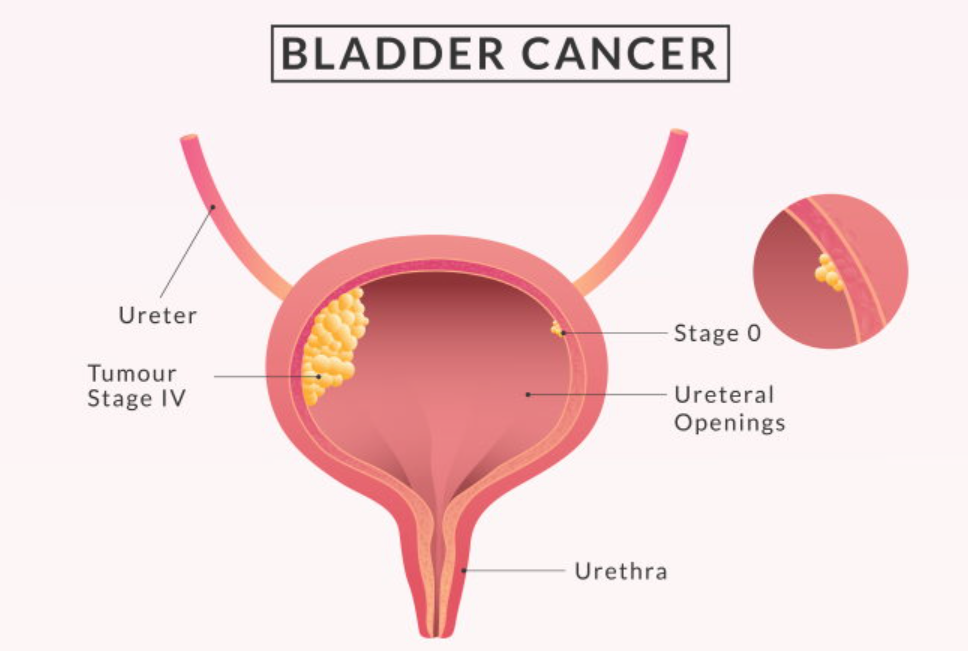 Bladder-Cancer