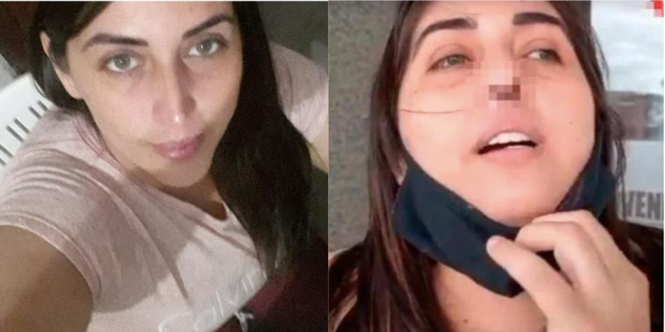 Mujer dice que le realizaron mal una prueba PCR; perdió cartílago de su nariz