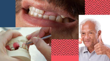 Removable Partial Dentures - Udemy