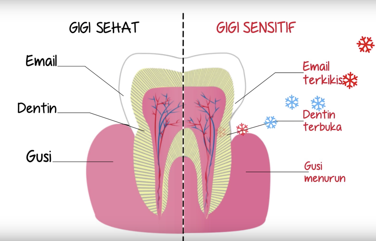 perbandingan gigi sehat dan gigi sensitif