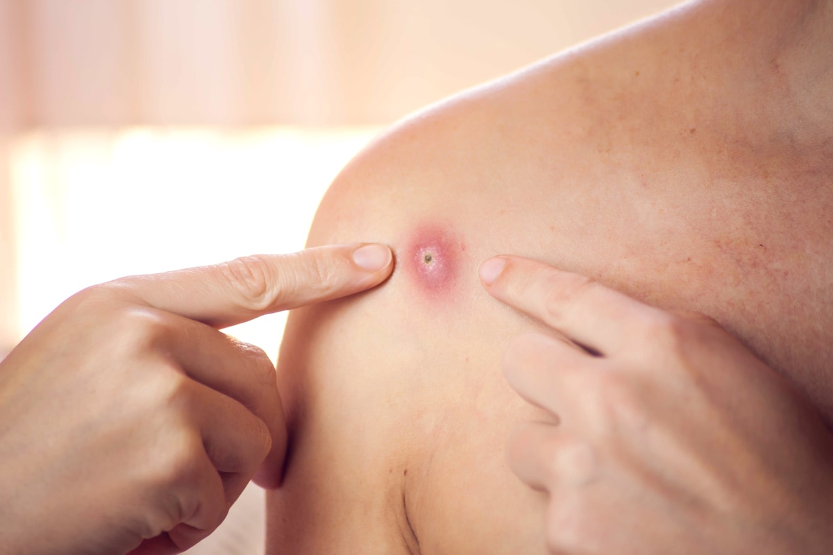 Viruela del mono se expande por el mundo, hay casos en diez países