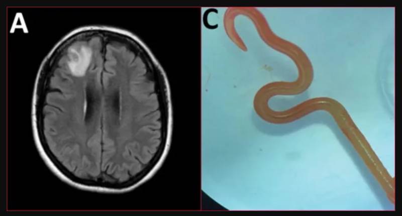 Dottori estraggono verme vivo cervello donna Australia