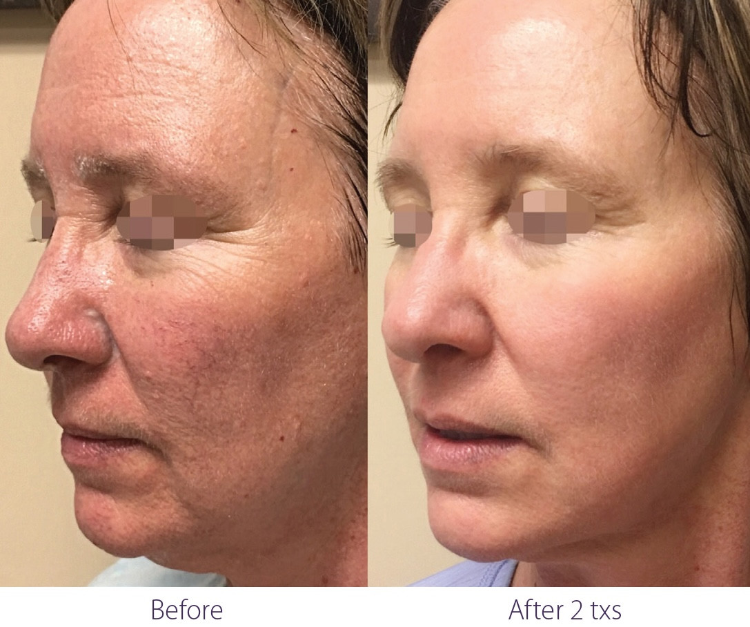 Natural-looking IPL results at Let's Face It Med Spa in Denver.