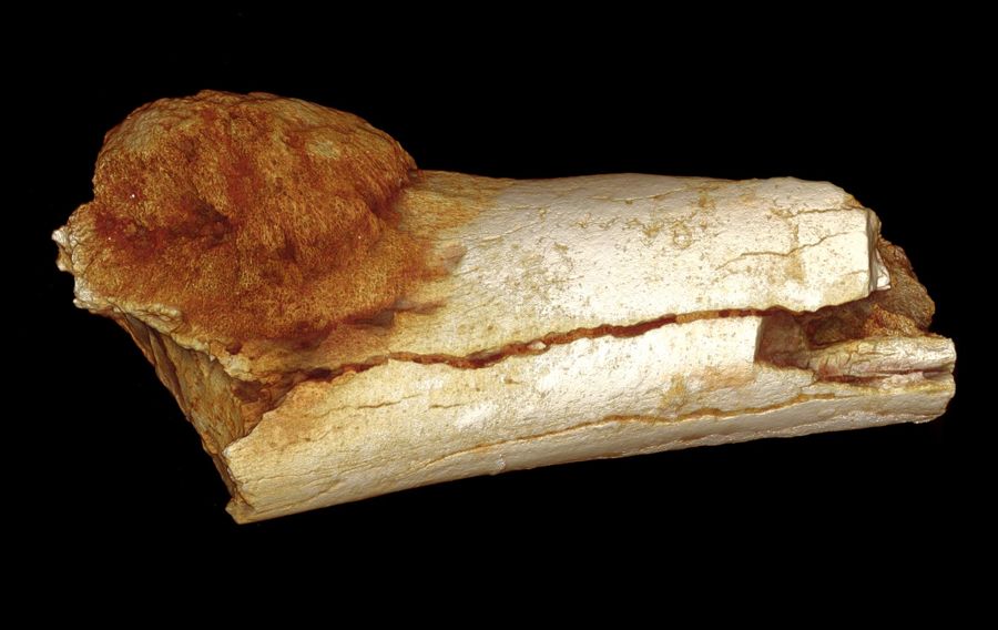 tumore cancro osteosarcoma grotta di Swartkrans in Sud Africa