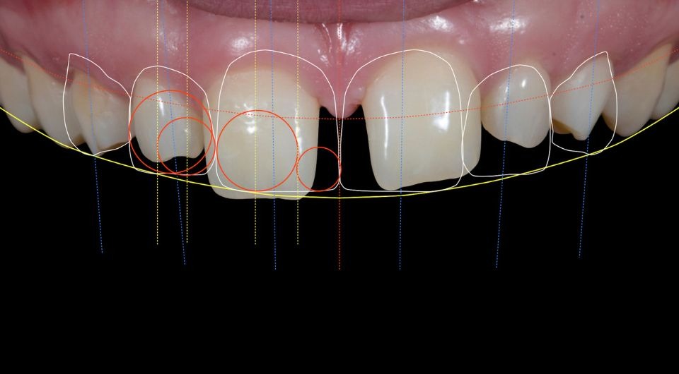 Smile Designing & Digital Smile Simulation