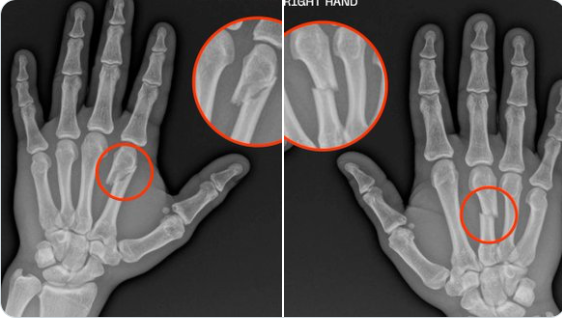 Жеан Силва си счупил ръцете в битката с Дрю Добър