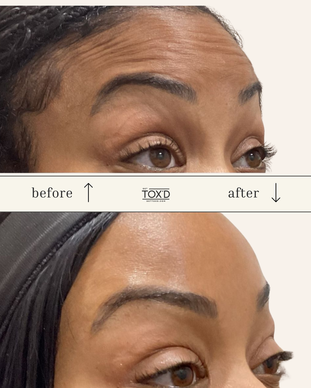 Brotox (Unlimited Upper Face)