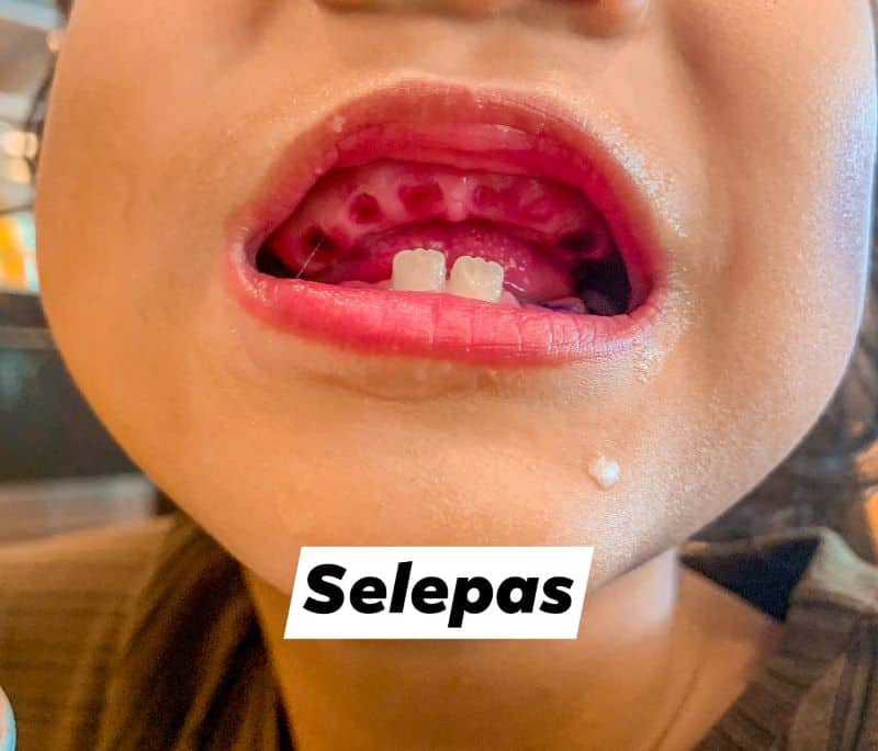 Bengkak Gusi Sampai Reput, Budak Terpaksa Buang Hampir 