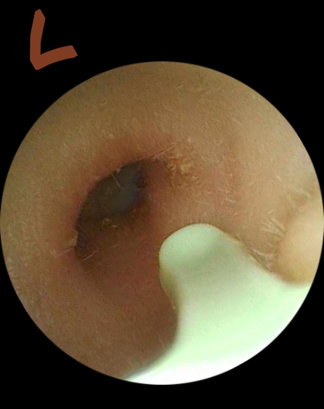 Left outer