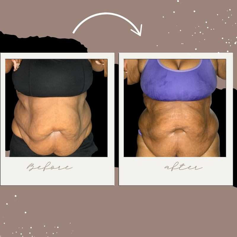 Body Sculpting Results