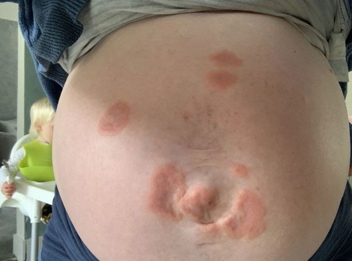 Mujer que es alérgica a su hijo conmueve al mundo